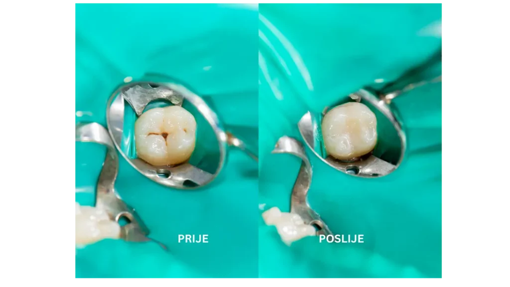 prije plombe i posluje plombe